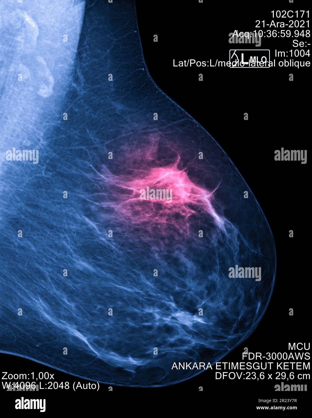 Mammogram radio imaging per la diagnosi di cancro al seno, mostra zona dolore con rosso. Screening radiologico per il rilevamento precoce del cancro al seno. Imaging medicale c Foto Stock