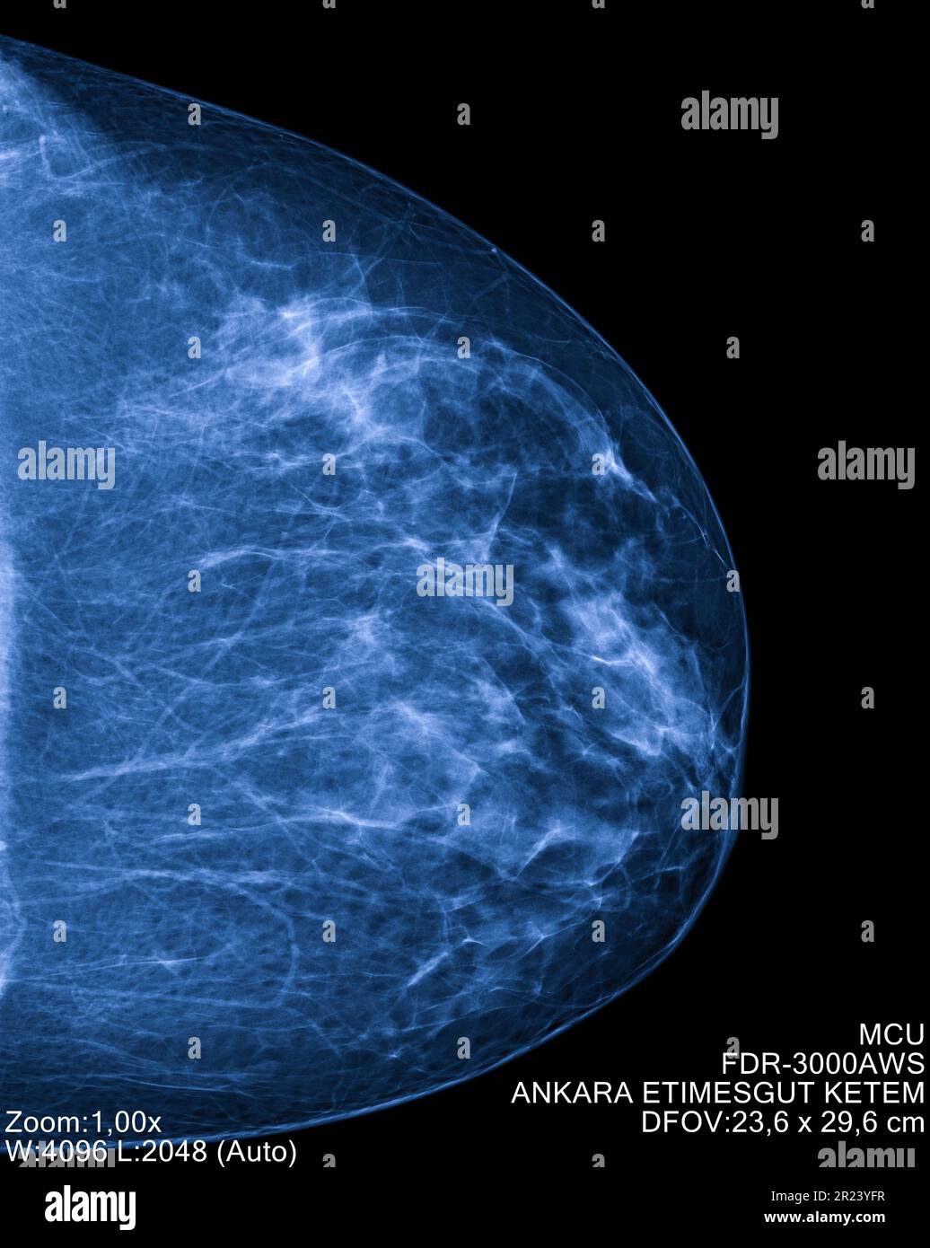 Imaging radio mammografico per la diagnosi del cancro al seno. Screening radiologico per il rilevamento precoce del cancro al seno. Concetto di imaging medicale Foto Stock