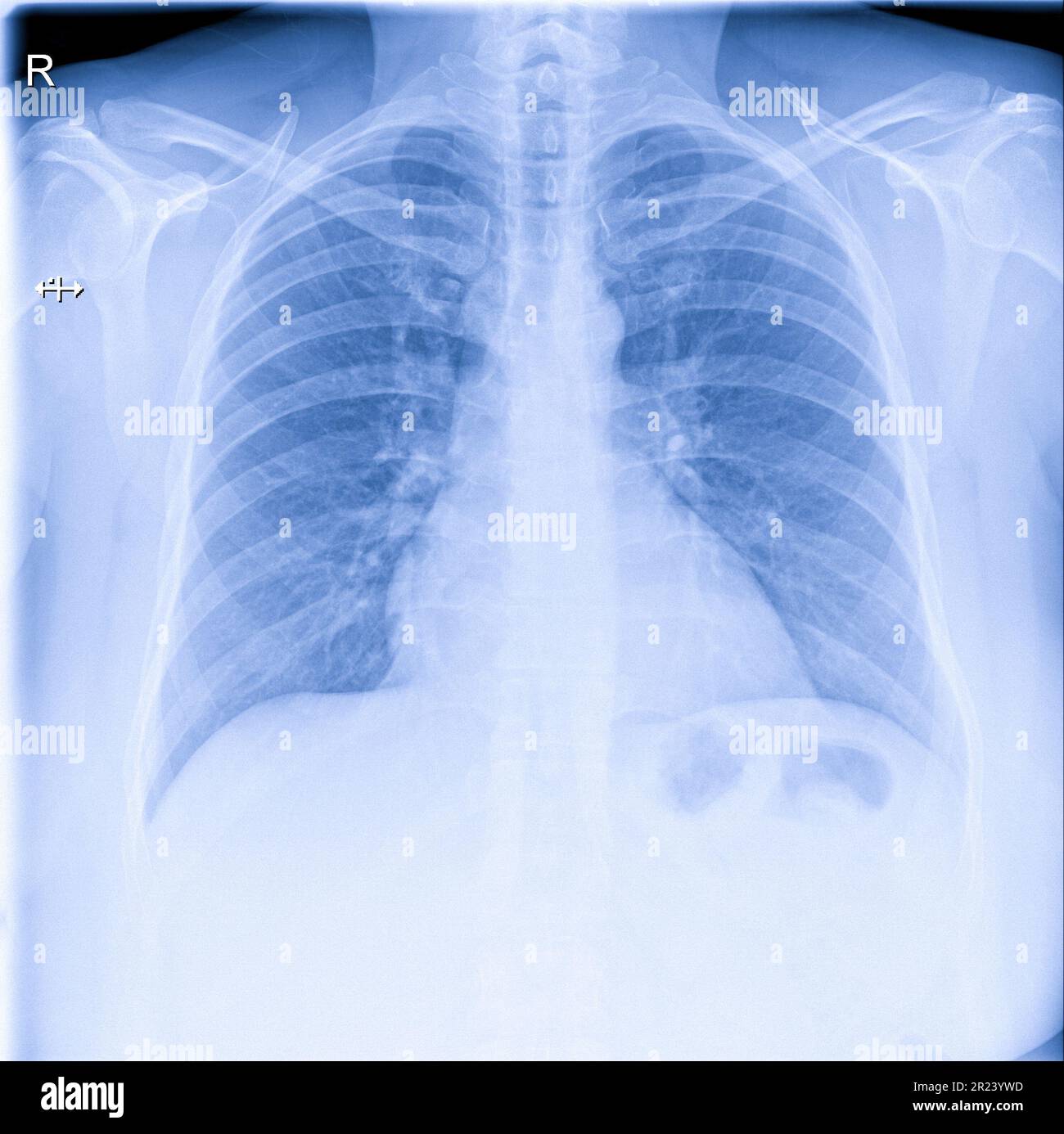 Immagine a raggi X del torace dell'uomo per una diagnosi medica Foto Stock