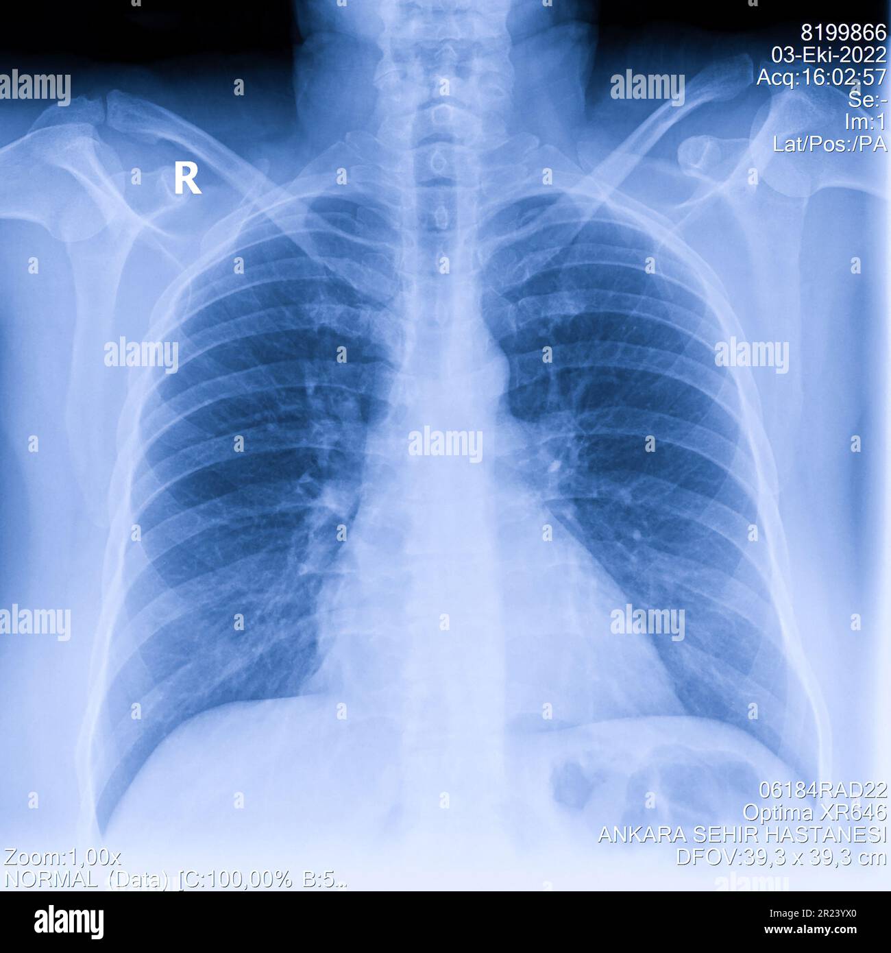Radiografia toracica umana per esame polmonare, PA in alto a destra. Polmoni infetti da cancro. Screening dei virus Foto Stock