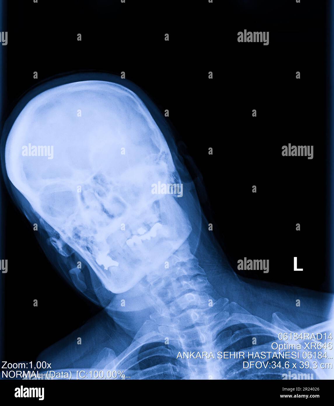 Radiografia della colonna cervicale umana, del collo Foto Stock