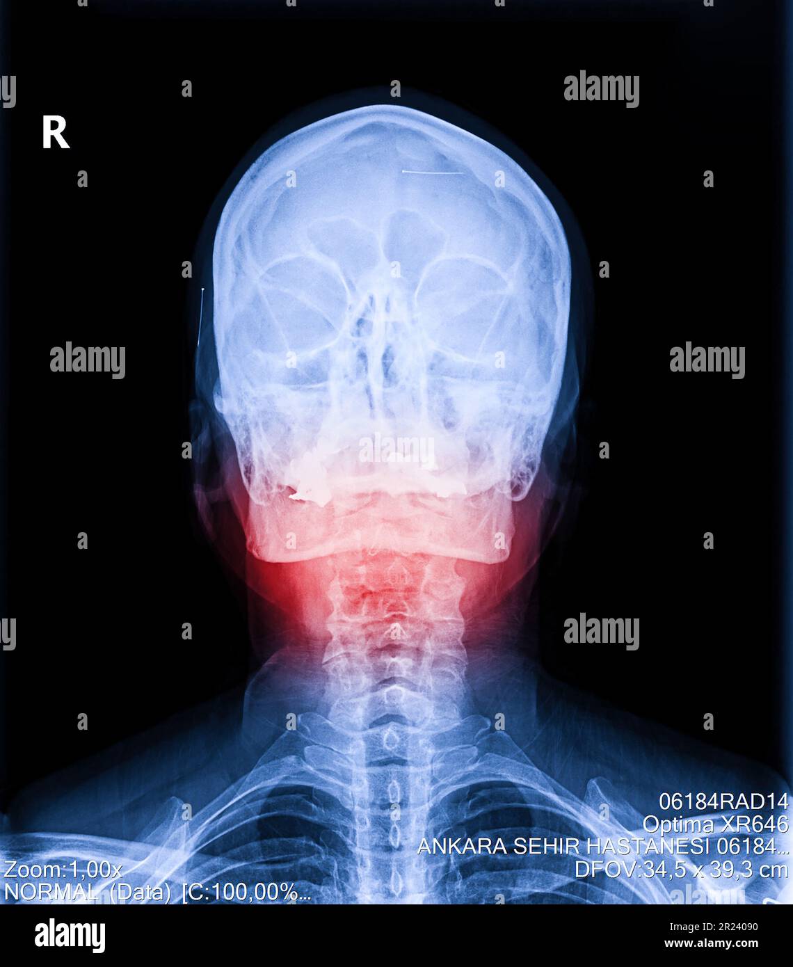 Vista radiografica del collo e della colonna cervicale. Immagine della radiografia di pazienti con dolore al collo e alla mandibola, compressione della radice nervosa Foto Stock