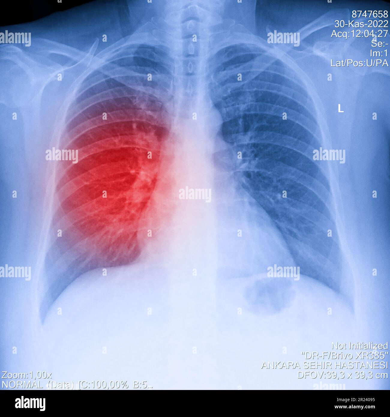 Immagine radiografica del torace umano per una diagnosi medica, mostra l'area del dolore con il rosso. Radiografia toracica per esame polmonare, PA in alto a destra Foto Stock