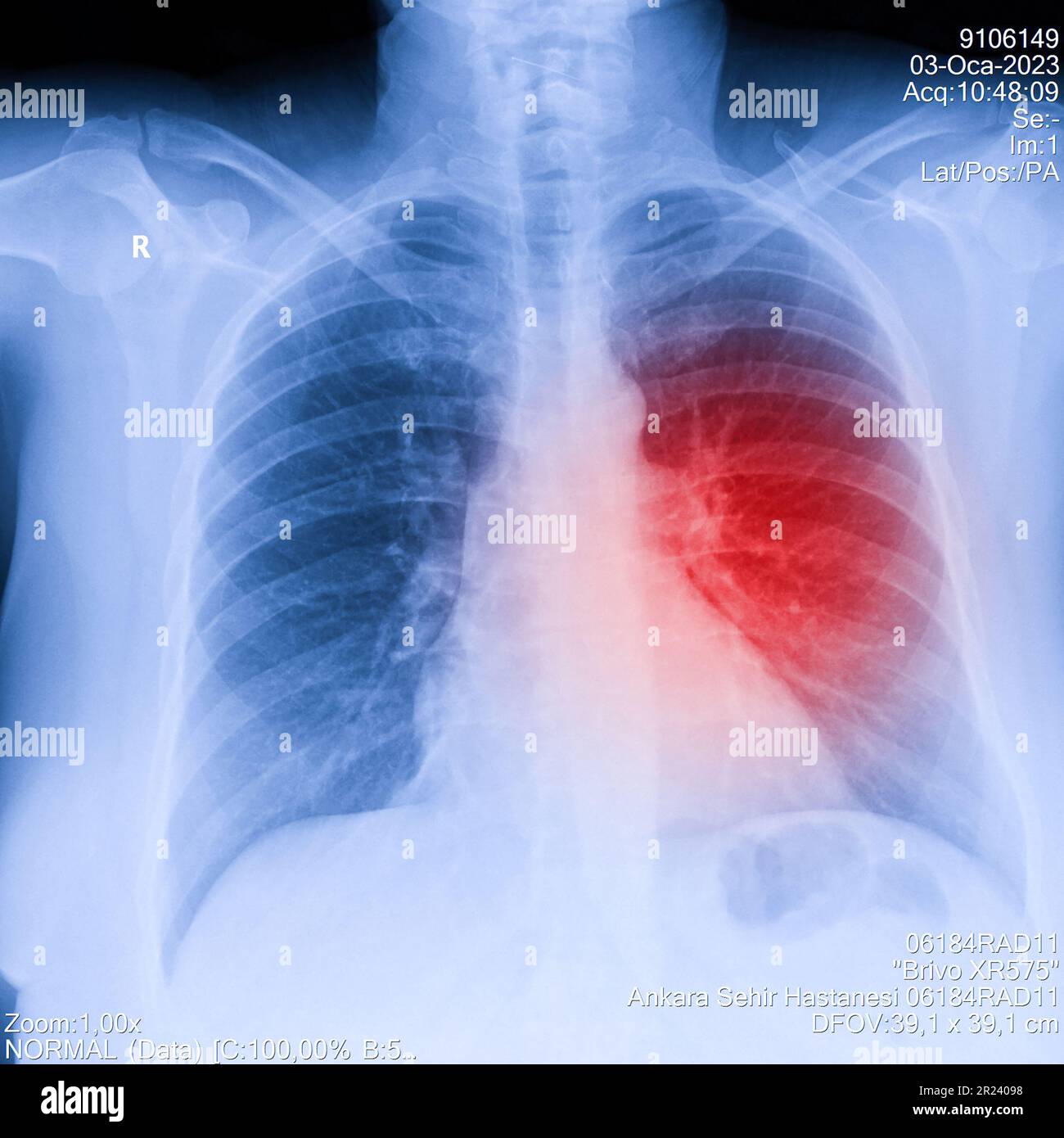 Immagine radiografica del torace umano per una diagnosi medica, mostra l'area del dolore con il rosso. Radiografia toracica per esame polmonare, PA in alto a destra Foto Stock
