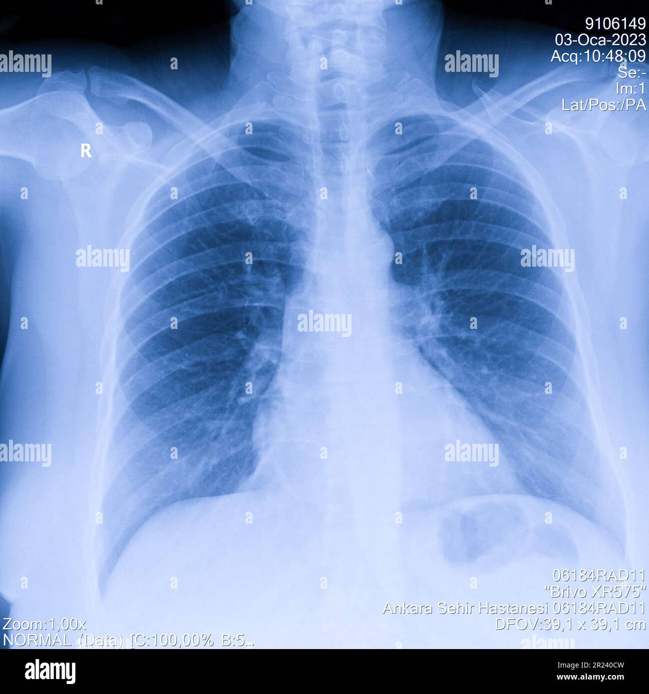 Radiografia toracica umana per esame polmonare, PA in alto a destra. Polmoni infetti da cancro. Screening dei virus Foto Stock