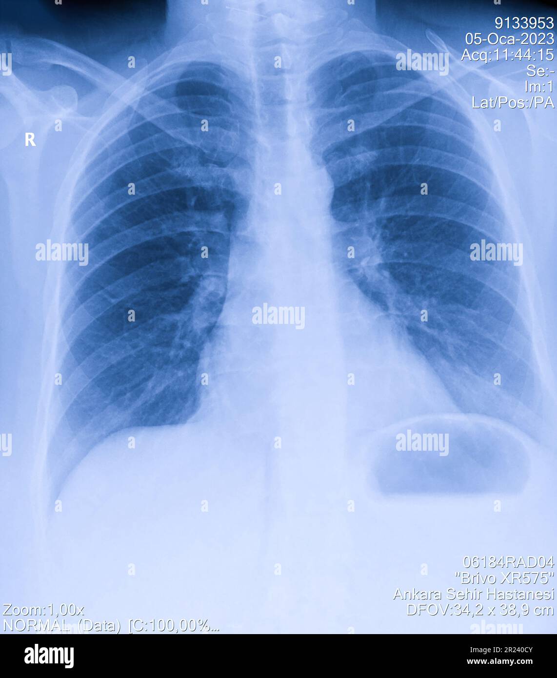 Immagine a raggi X del torace dell'uomo per una diagnosi medica Foto Stock