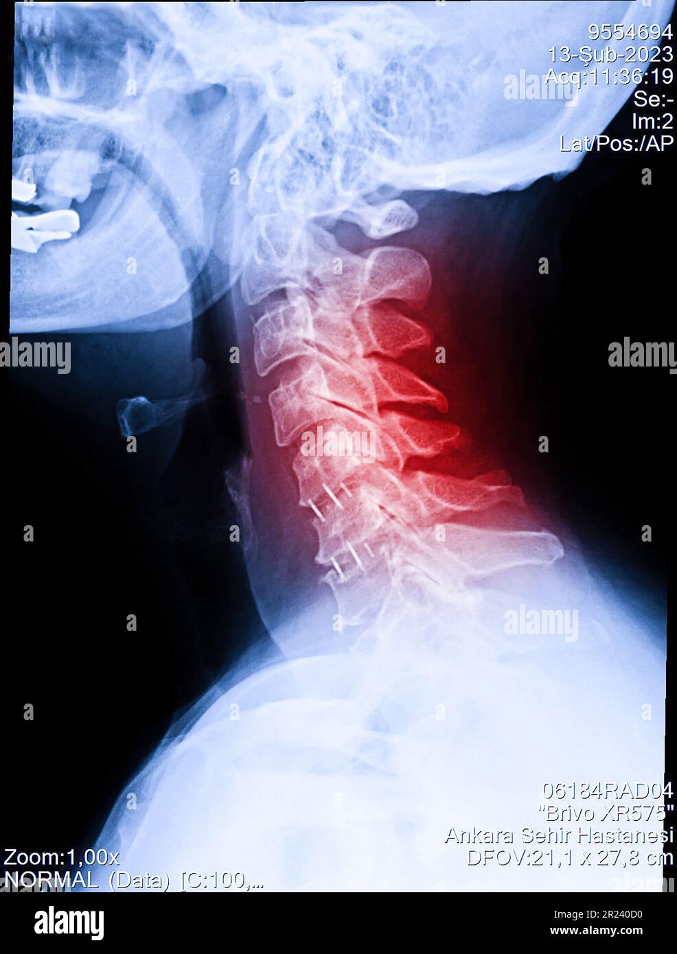 Vista radiografica del collo e della colonna cervicale. Immagine della radiografia di pazienti con dolore al collo, compressione della radice nervosa, intorpidimento al polso o all'aletta della mano del braccio Foto Stock