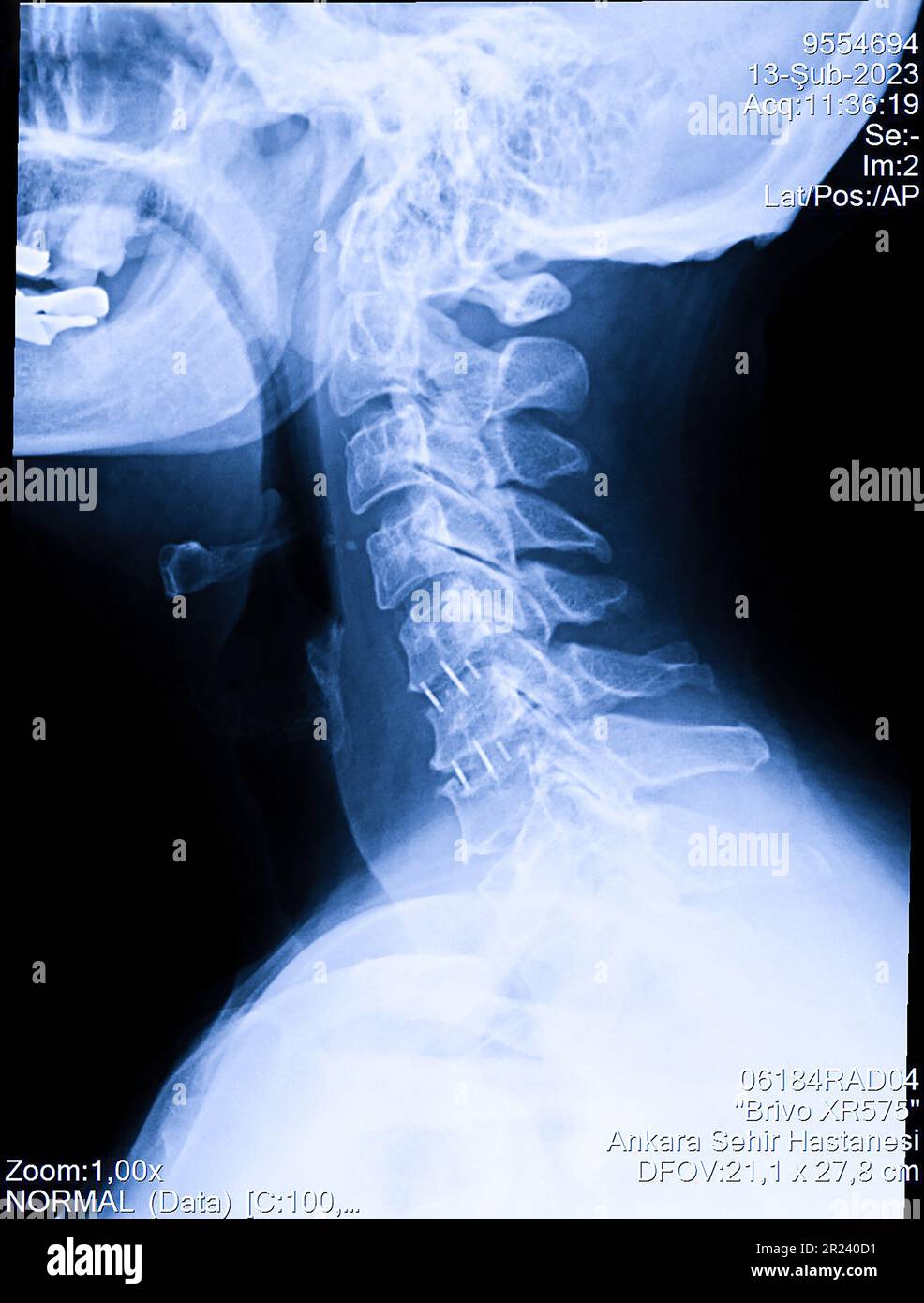 Radiografia della colonna cervicale della donna, radiografia del collo umano Foto Stock