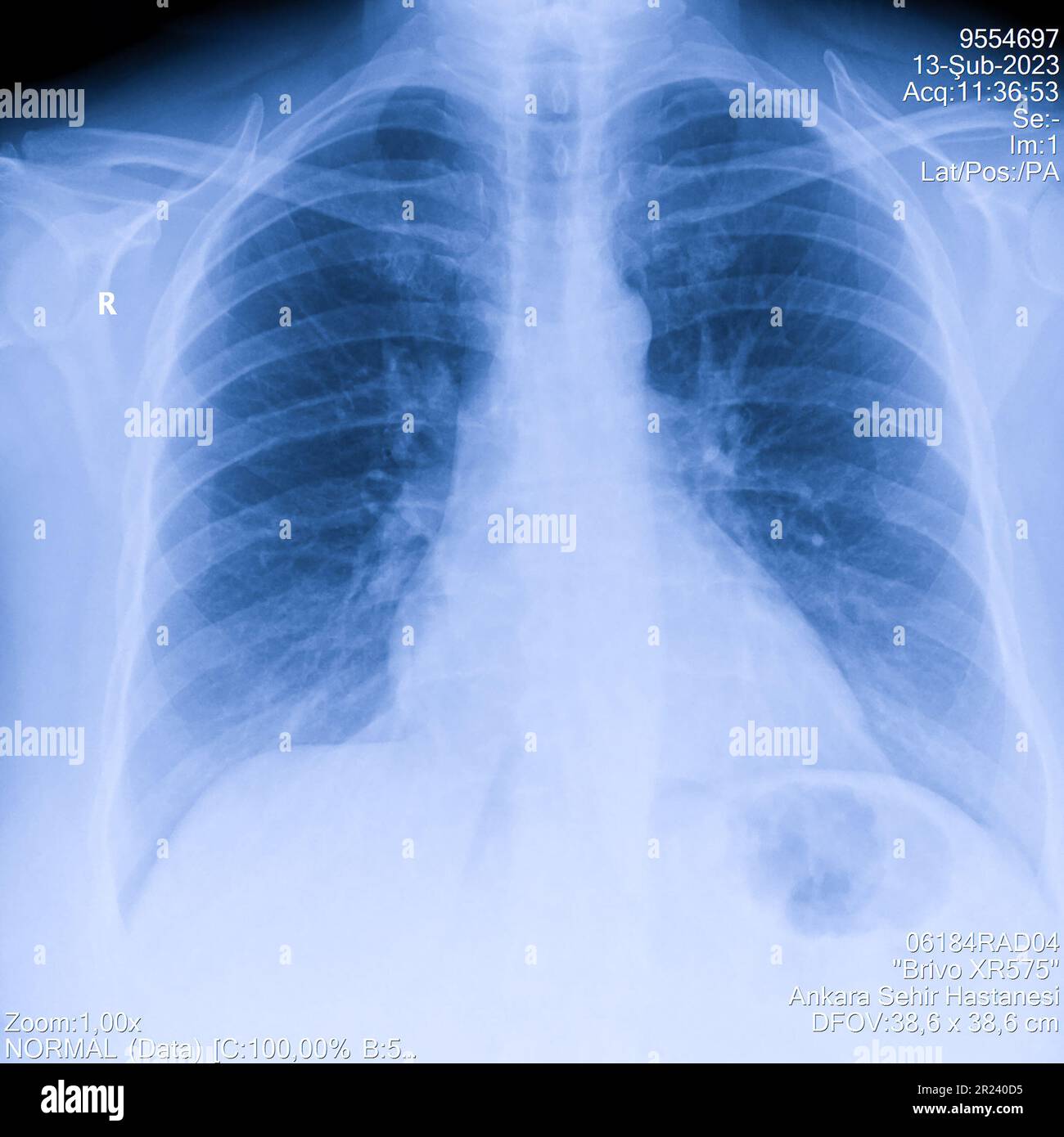 Radiografia toracica umana per esame polmonare, PA in alto a destra. Polmoni infetti da cancro. Screening dei virus Foto Stock