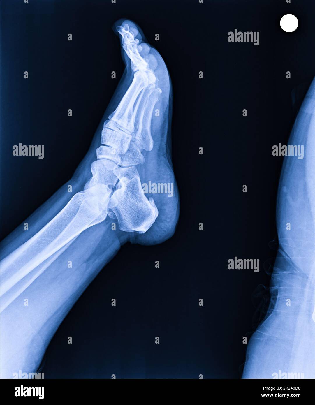 X-ray umano normale il piede laterale Foto Stock
