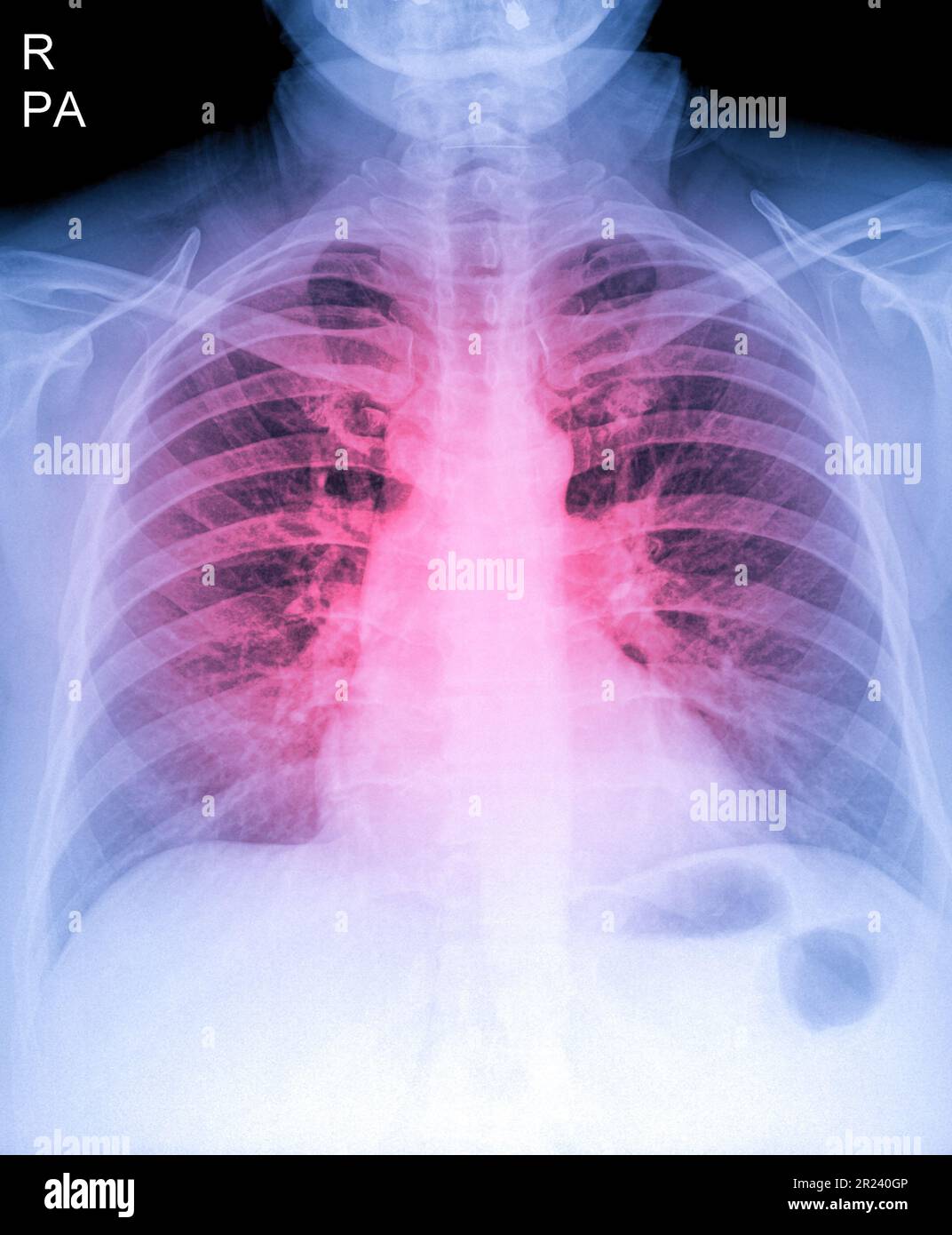 Immagine radiografica del torace umano per una diagnosi medica, mostra l'area del dolore con il rosso. Radiografia toracica per esame polmonare, PA in alto a destra Foto Stock