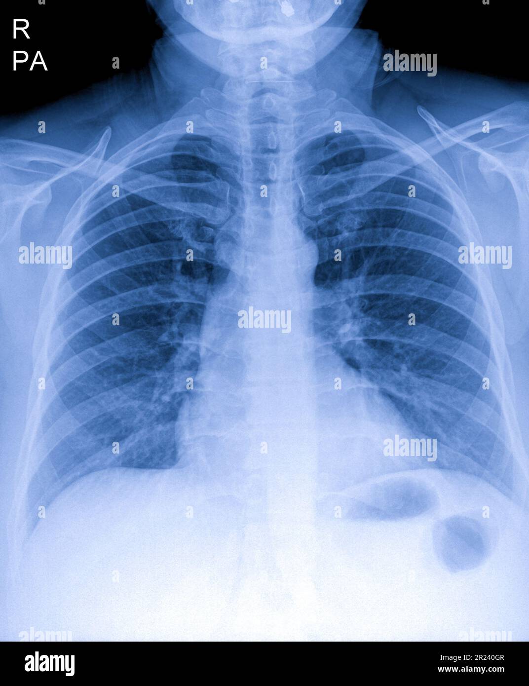 Radiografia toracica umana per esame polmonare, PA in alto a destra. Polmoni infetti da cancro. Screening dei virus Foto Stock