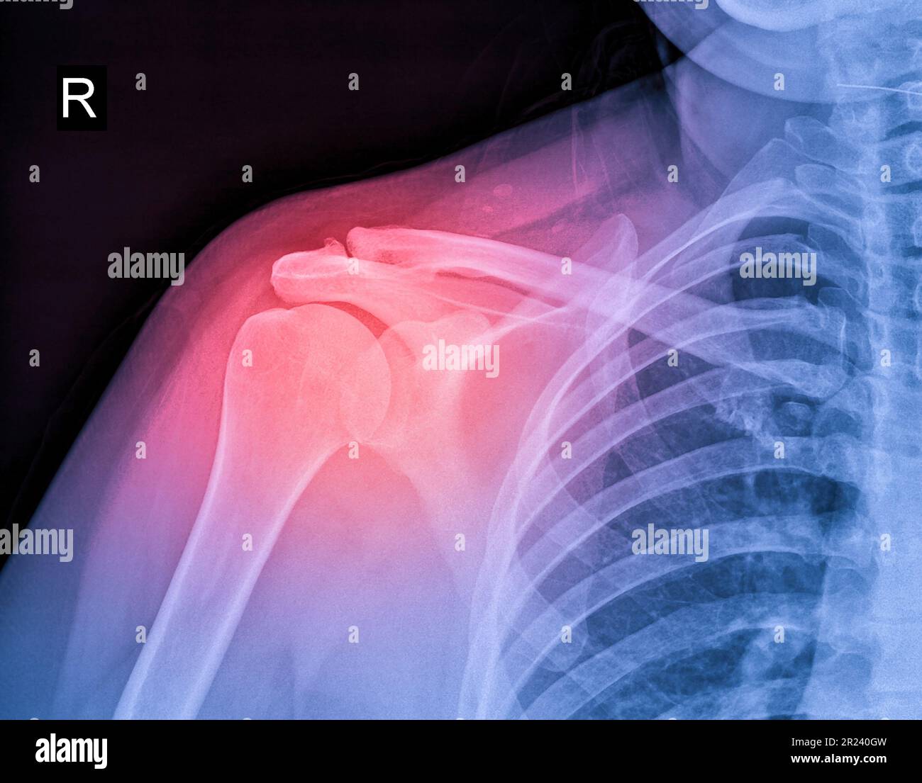 Immagine radiografica di dolore alla spalla, tendinite del legamento della spalla, sforzo muscolare della spalla Foto Stock