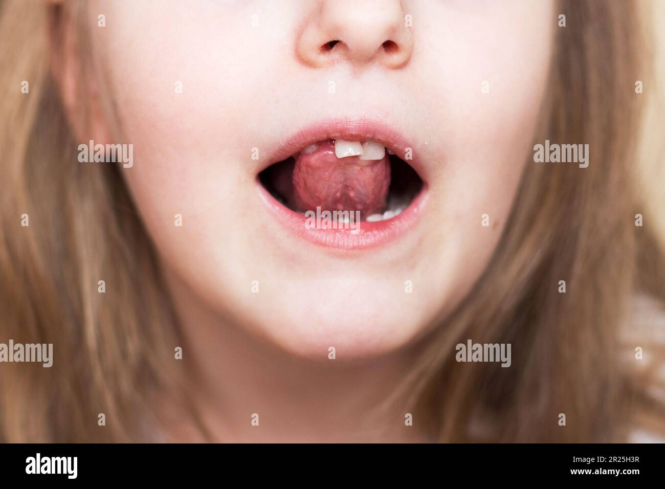 Primo piano ritratto di una ragazza sorridente bambino felice con capelli lunghi che muove il suo dente anteriore del latte con la lingua in bocca aperta. Conce di perdita dei denti del latte Foto Stock