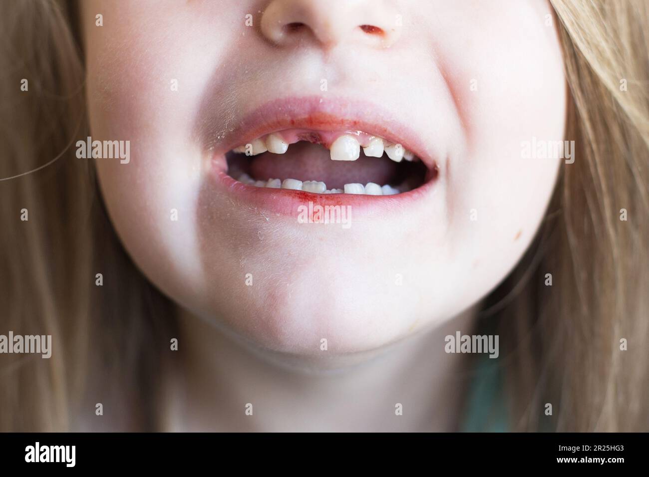 Una ragazza carina ha perso il suo dente del latte del bambino anteriore. Bambino con ferita fresca dopo aver estratto il dente del latte. Il concetto di igiene orale nei bambini. Chiudi- Foto Stock