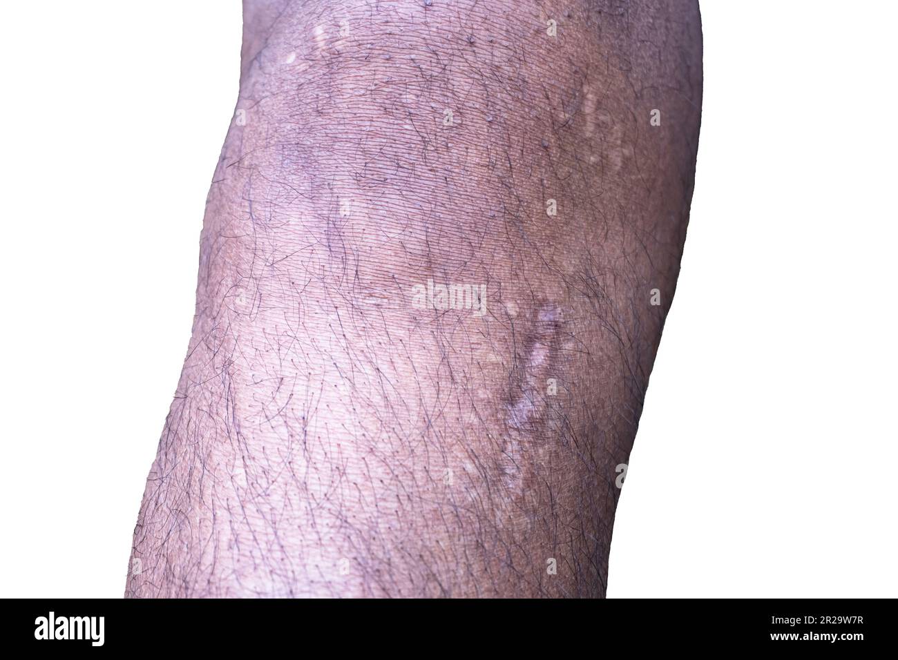 Un uomo ginocchio dopo chirurgia artroscopica. Lesione del legamento crociato anteriore isolata su sfondo bianco con percorso di ritaglio e spazio di copia Foto Stock