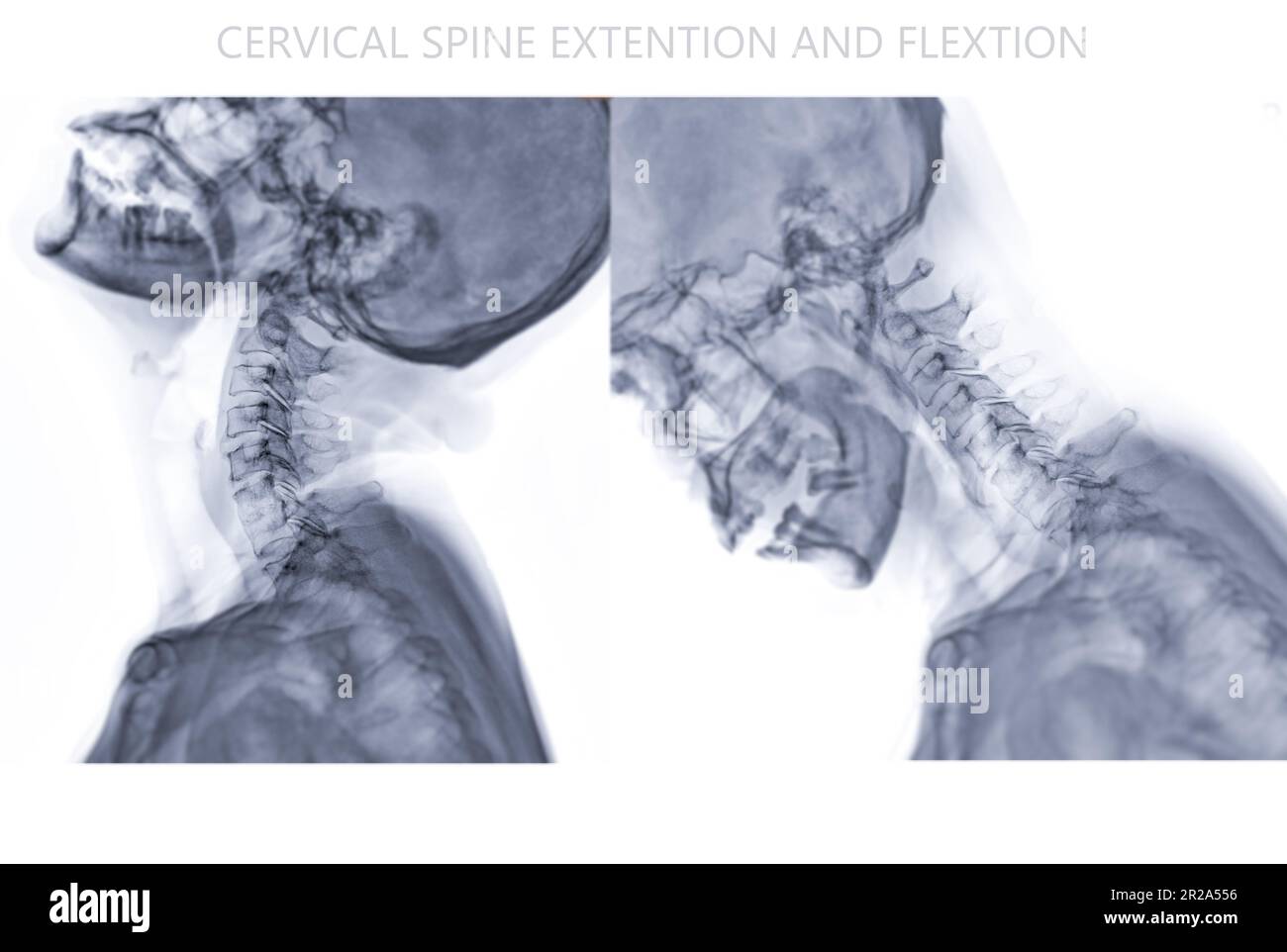Immagine radiografica della colonna vertebrale cervicale o radiografica della flessione cervicale della colonna vertebrale e della vista di estensione per l'erniazione diagnostica del disco intervertebrale, la spondilosi e la frattura. Foto Stock