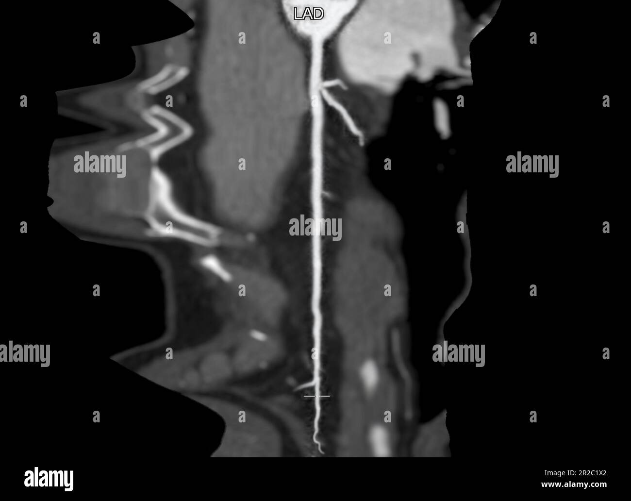 CTA coronary Artery Refomation curva che mostra l'arteria coronaria sinistra . Foto Stock