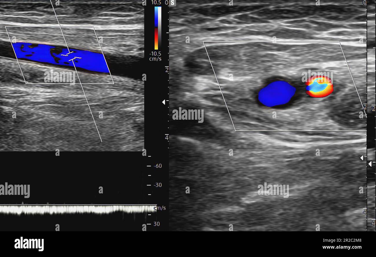 Un ecografo Doppler dell'arteria carotide è un test diagnostico utilizzato per controllare le arterie del collo per la diagnosi di eventuali ostruzioni nelle vene da parte di un cl di sangue Foto Stock