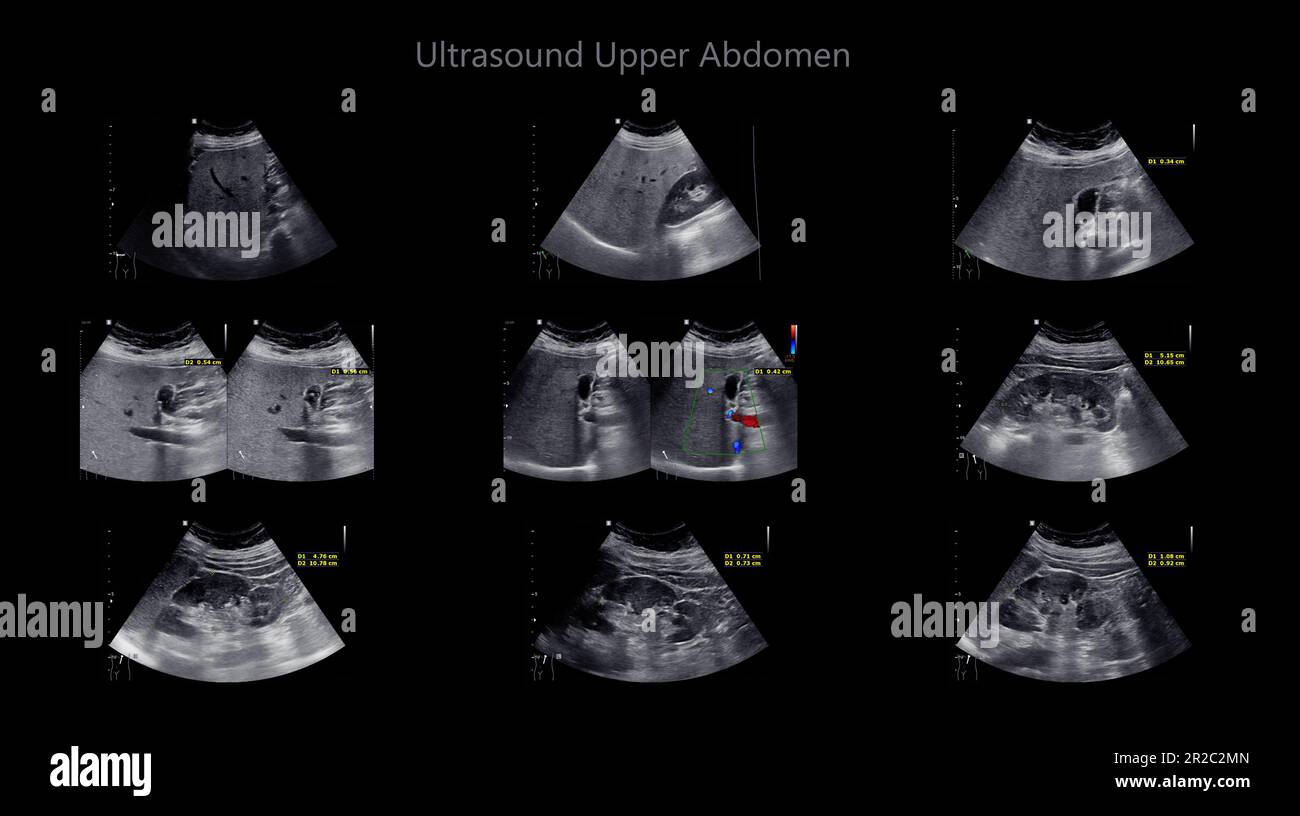 Ecografia dell'addome superiore che mostra fegato e cistifellea per lo screening del carcinoma epatico e calcoli biliari. Foto Stock