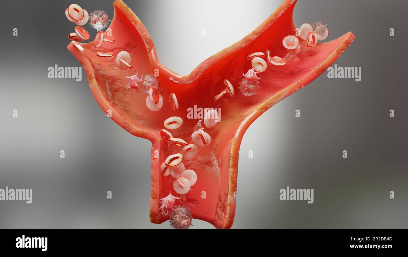 Anemia quantità di cellule ematiche o emoglobina e normale. Anemia aplastica, conta delle cellule ematiche e delle piastrine normali e anormali, circolazione in un'arteria o. Foto Stock