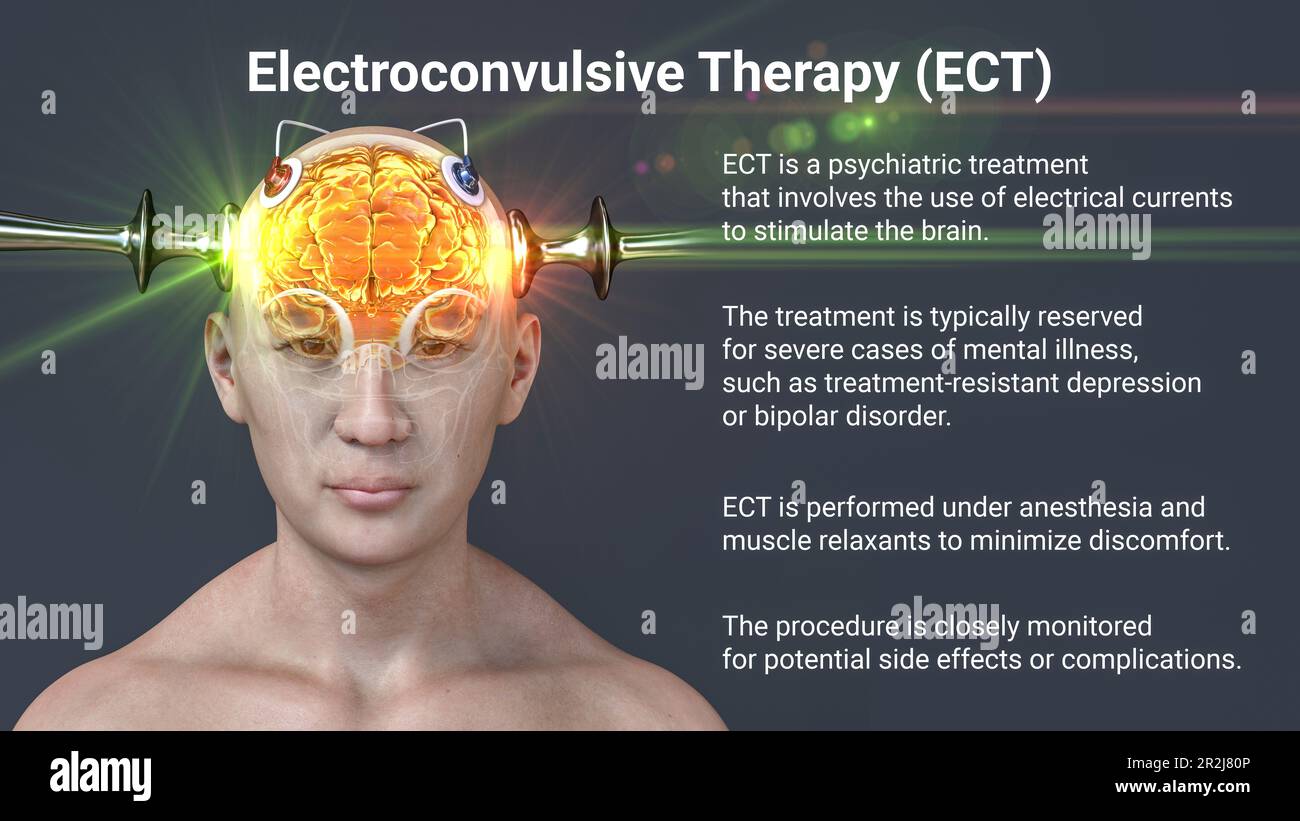 Terapia elettroconvulsiva, illustrazione Foto Stock