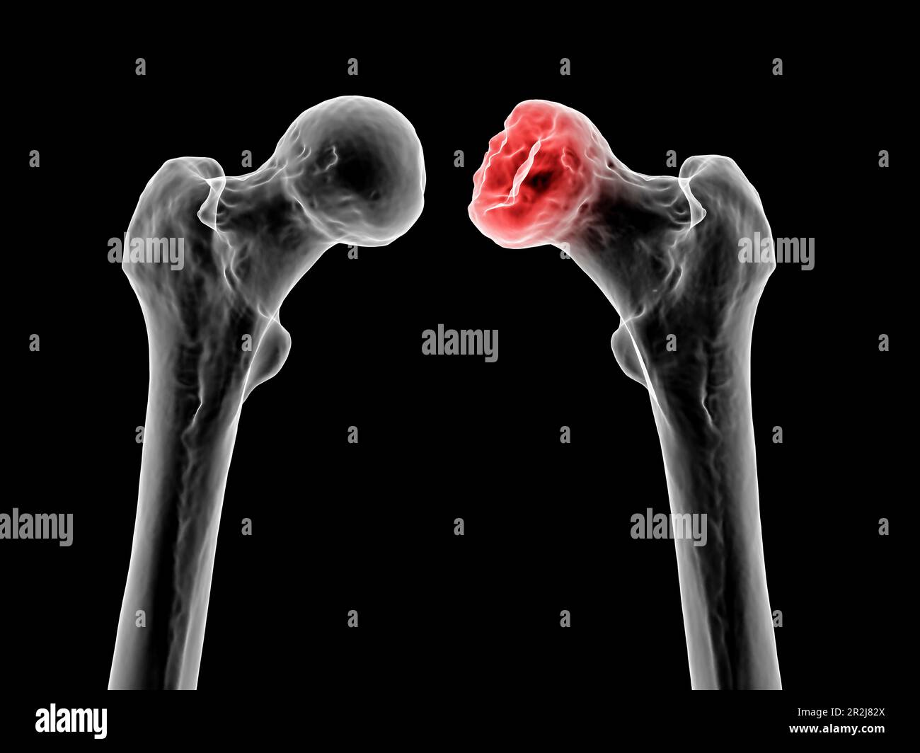 Malattia di Legg-Calve-Perthes, illustrazione Foto Stock