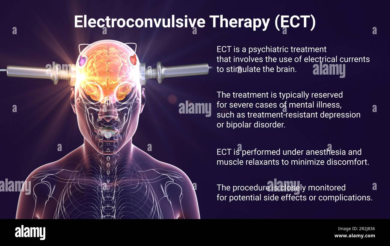 Terapia elettroconvulsiva, illustrazione Foto Stock