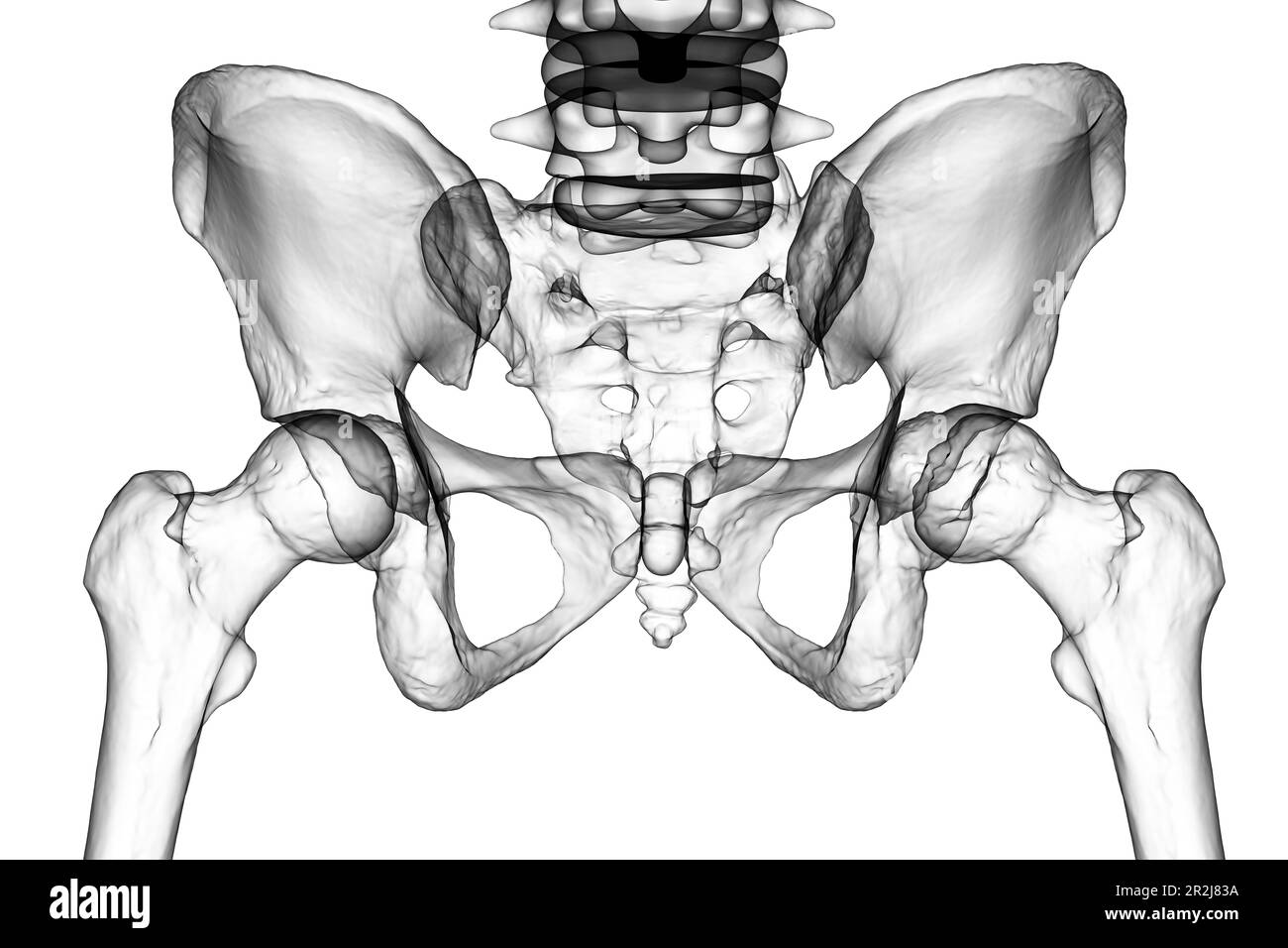 Malattia di Legg-Calve-Perthes, illustrazione Foto Stock