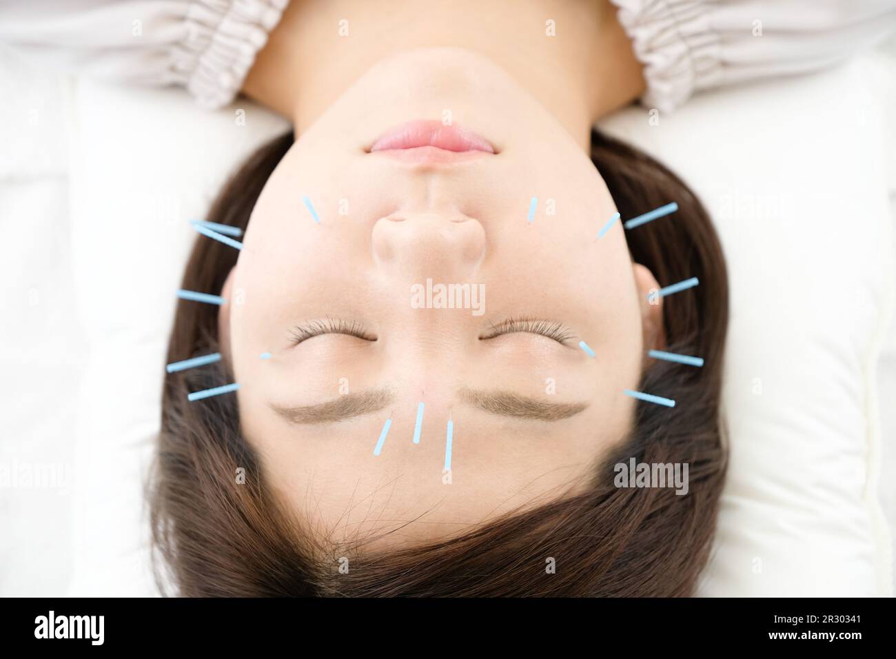 Su di una donna che ottiene agopuntura sul suo viso ad una clinica di agopuntura Foto Stock
