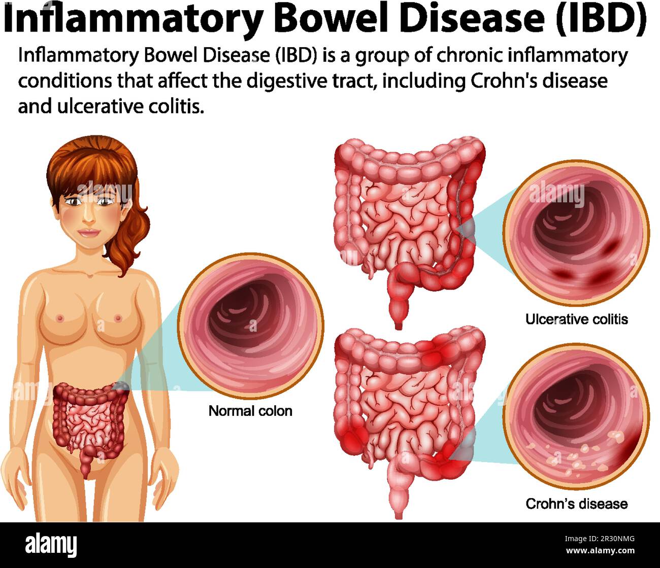 Infografica sulla malattia infiammatoria intestinale (IBD) Illustrazione Vettoriale