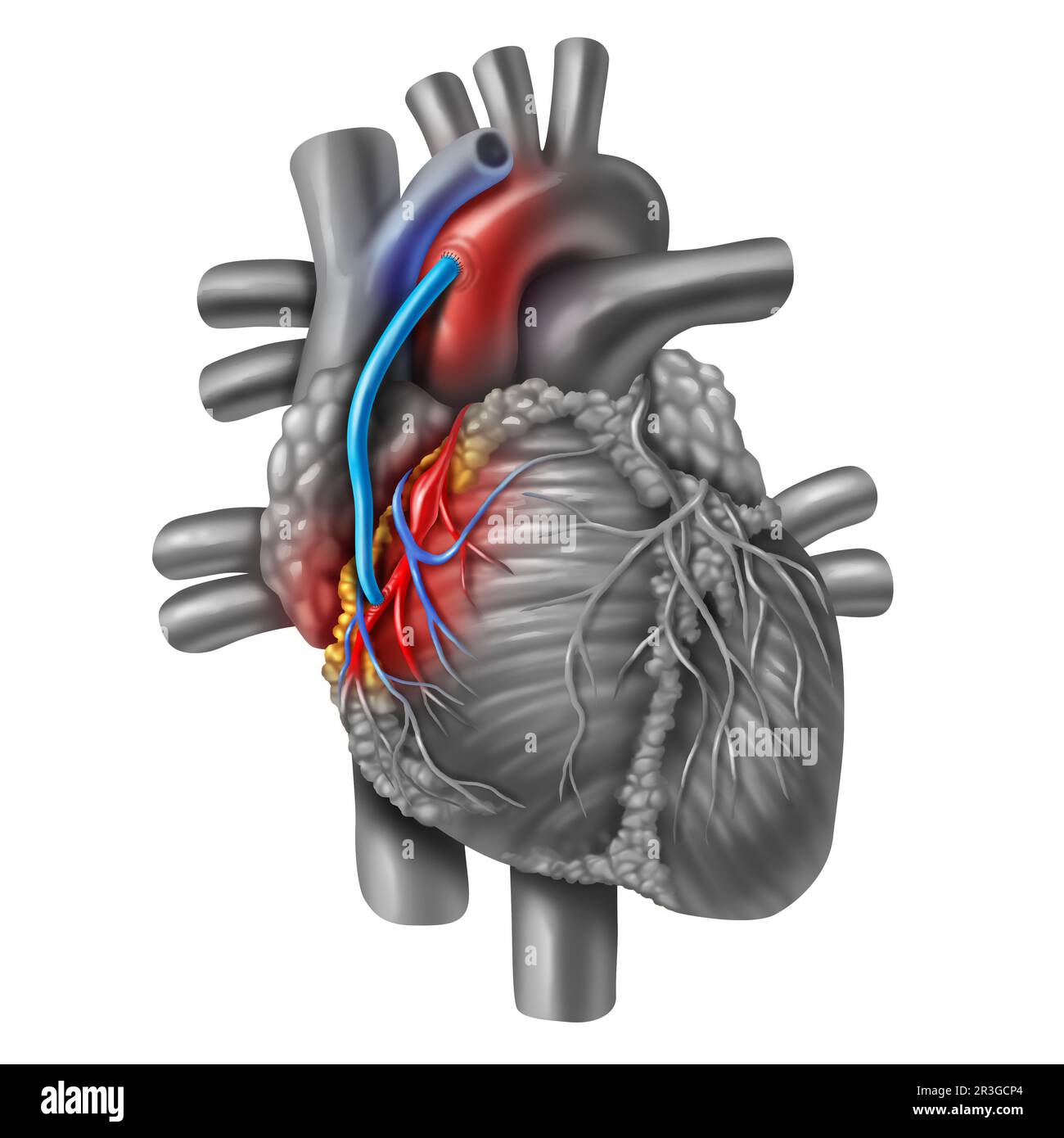 Innesto del bypass dell'arteria coronaria o CABG come ostruzione della placca nell'arteria coronaria o nelle arterie come vena da una gamba che è innestata a un cuore Foto Stock
