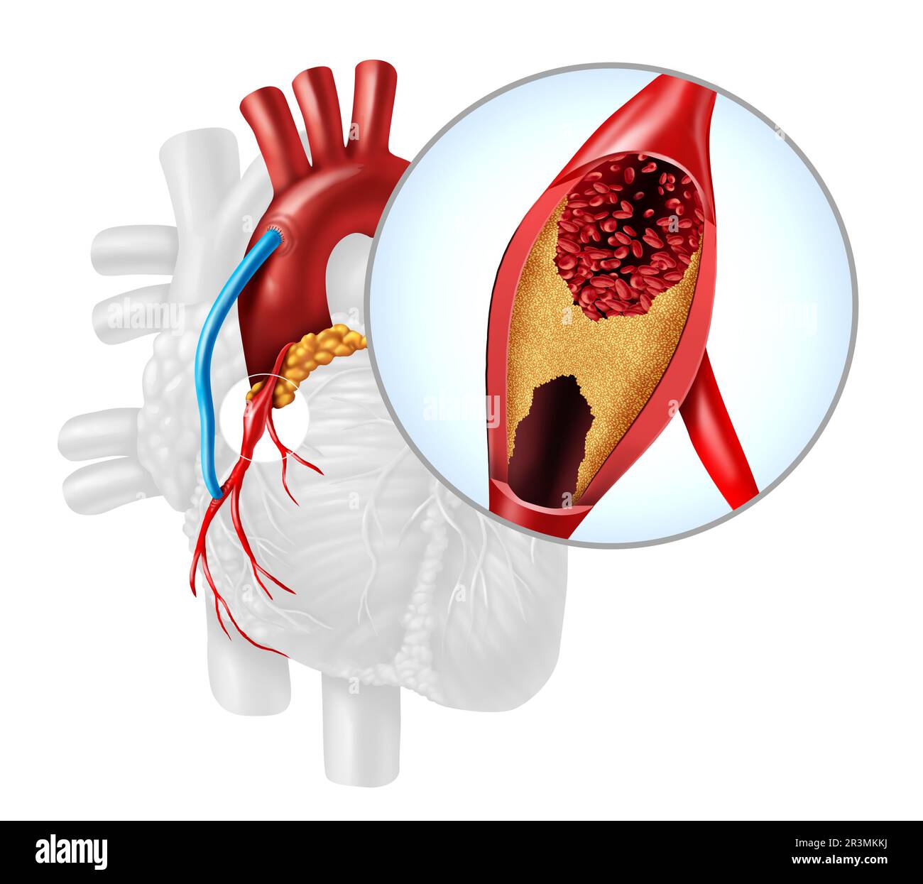 Bypass arteria cardiaca innesto o CABG come ostruzione della placca nell'arteria coronaria o arterie come vena da una gamba che è innestata a un cuore Foto Stock