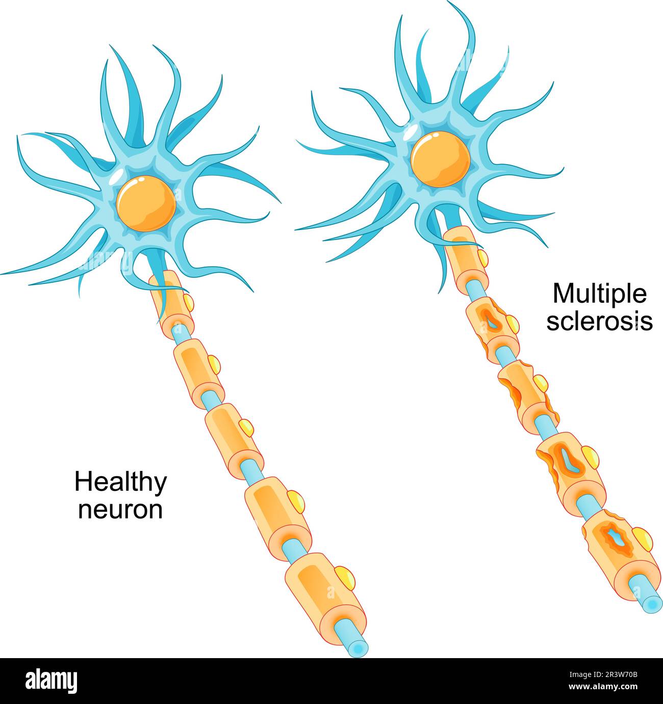 Sclerosi multipla. malattia autoimmune. confronto di un neurone sano e di un neurone con una guaina di mielina danneggiata. Nervo MS danneggiato dal sistema immunitario Illustrazione Vettoriale
