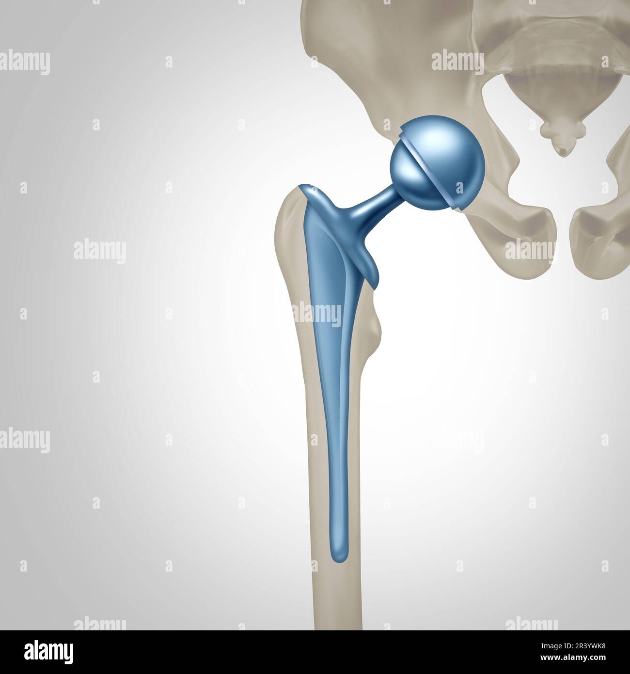 Concetto di Chirurgia di sostituzione dell'anca come articolazione artificiale o protesi con chirurgia ortopedica inserendo una sfera di metallo e una presa per sostituire un danneggiato da Foto Stock