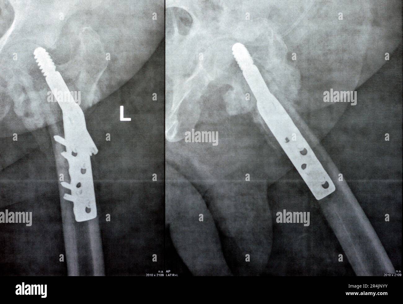 Collo cervicale trans dell'anca sinistra della frattura femorale fissato da DHS Dynamic Hip Screw, Plain x ray PXR di un vecchio paziente, una testa femorale-risparmiatore ortopedico Foto Stock