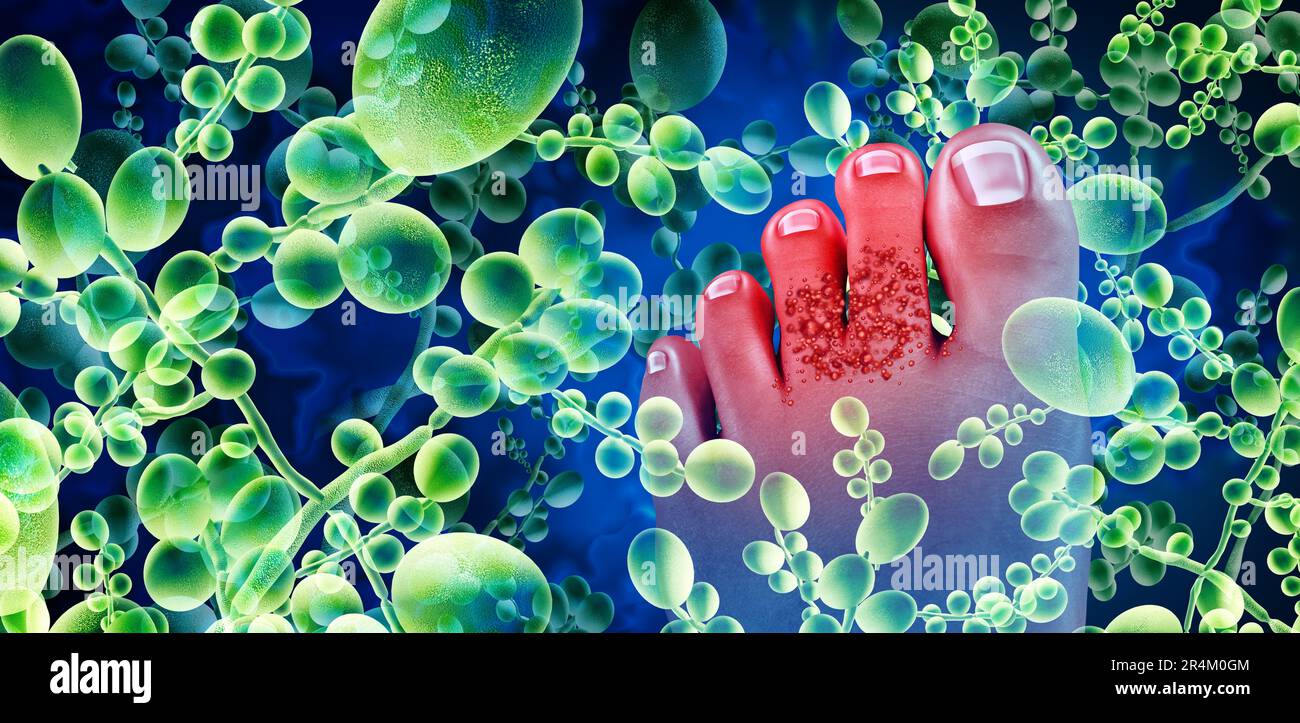 Infezione fungina piede e fungo piedi o contaminazione di funghi come un concetto medico di dermatologia o podiatria con 3D elementi di illustrazione. Foto Stock