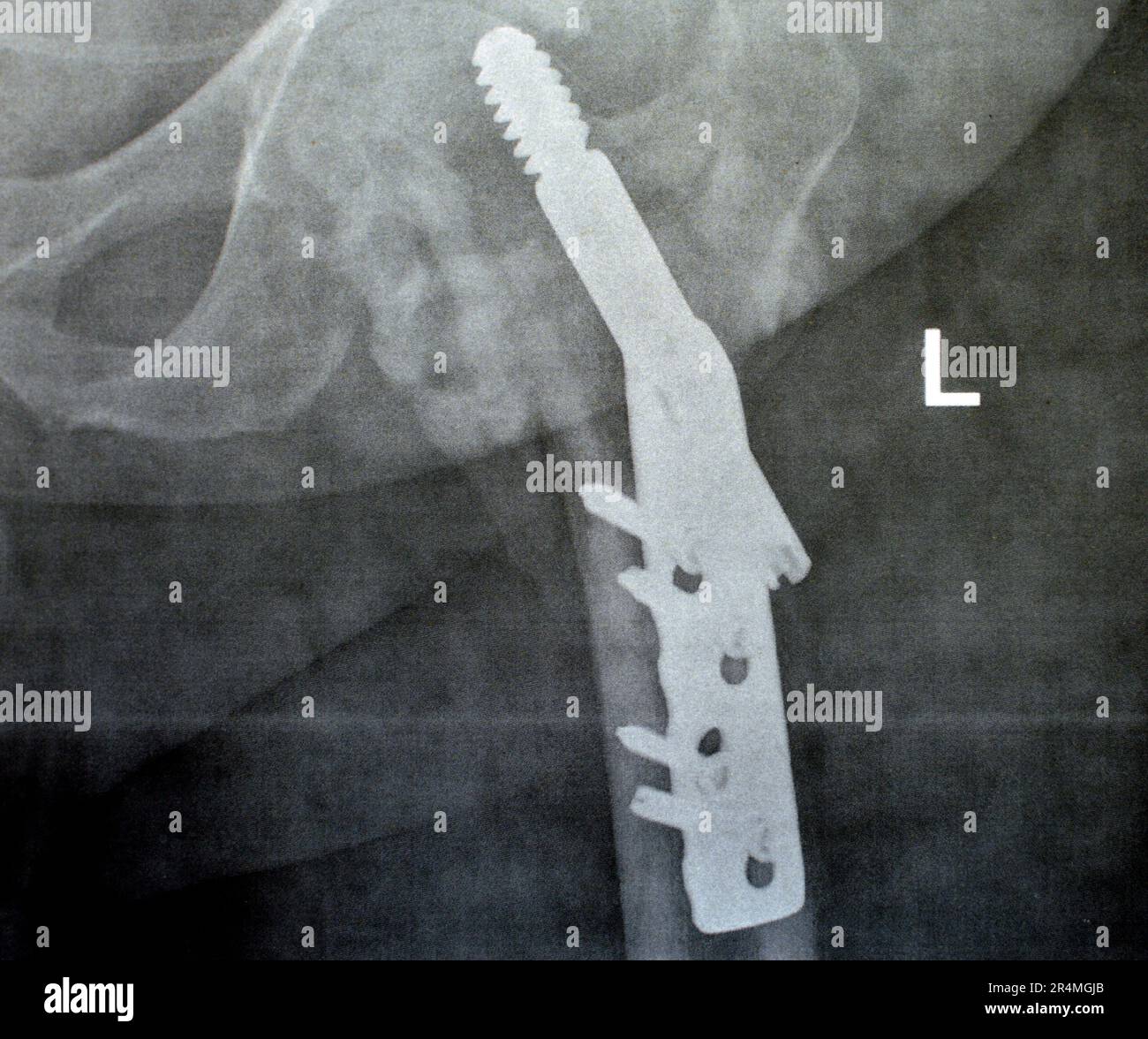 Collo cervicale trans dell'anca sinistra della frattura femorale fissato da DHS Dynamic Hip Screw, Plain x ray PXR di un vecchio paziente, una testa femorale-risparmiatore ortopedico Foto Stock
