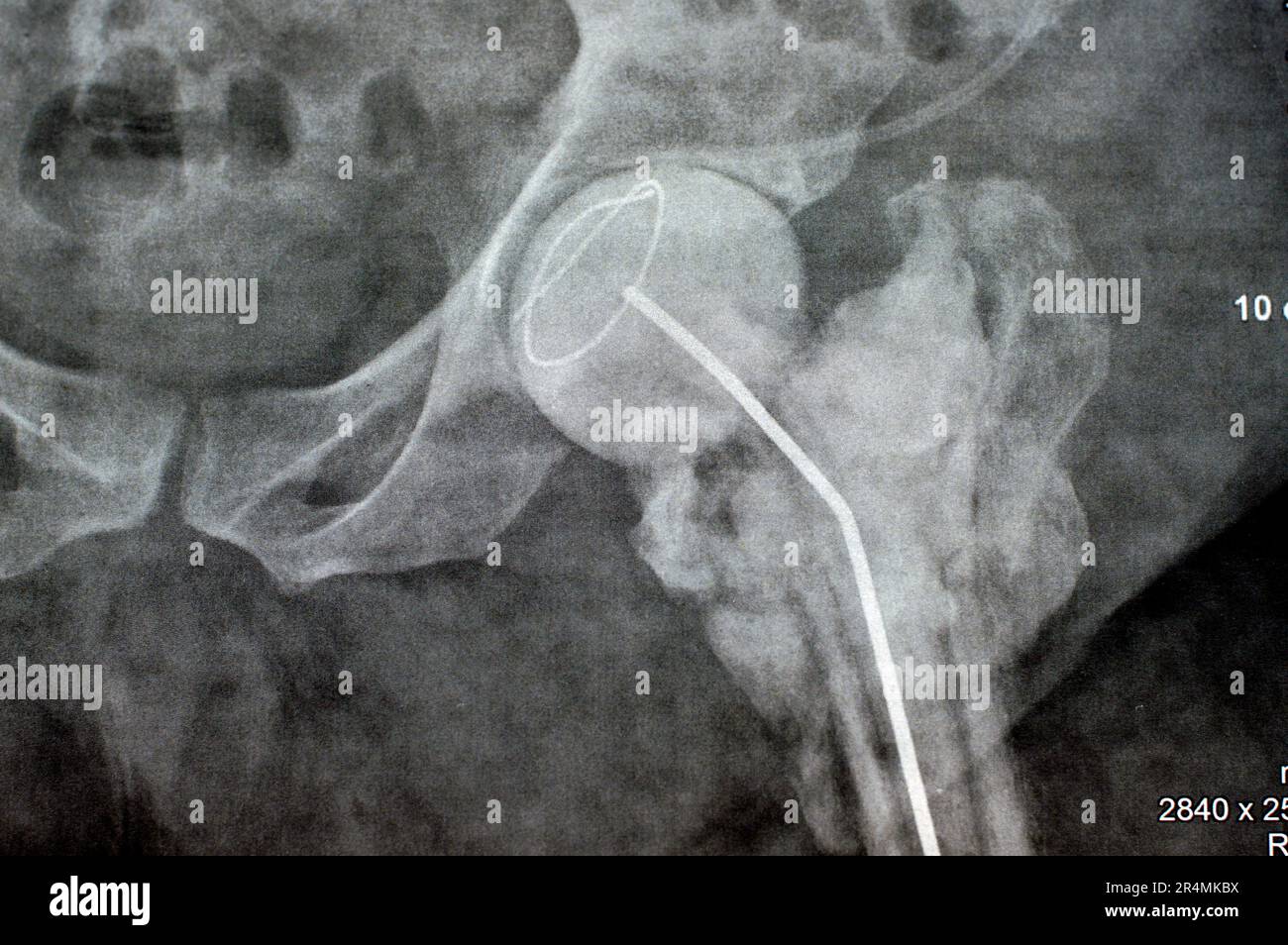 L'articolazione dell'anca a raggi X normali mostra la frattura trans cervicale sinistra della testa del femore con distanziatore temporaneo del caricatore antibiotico a poppa di cemento osseo caricato con antibiotici Foto Stock