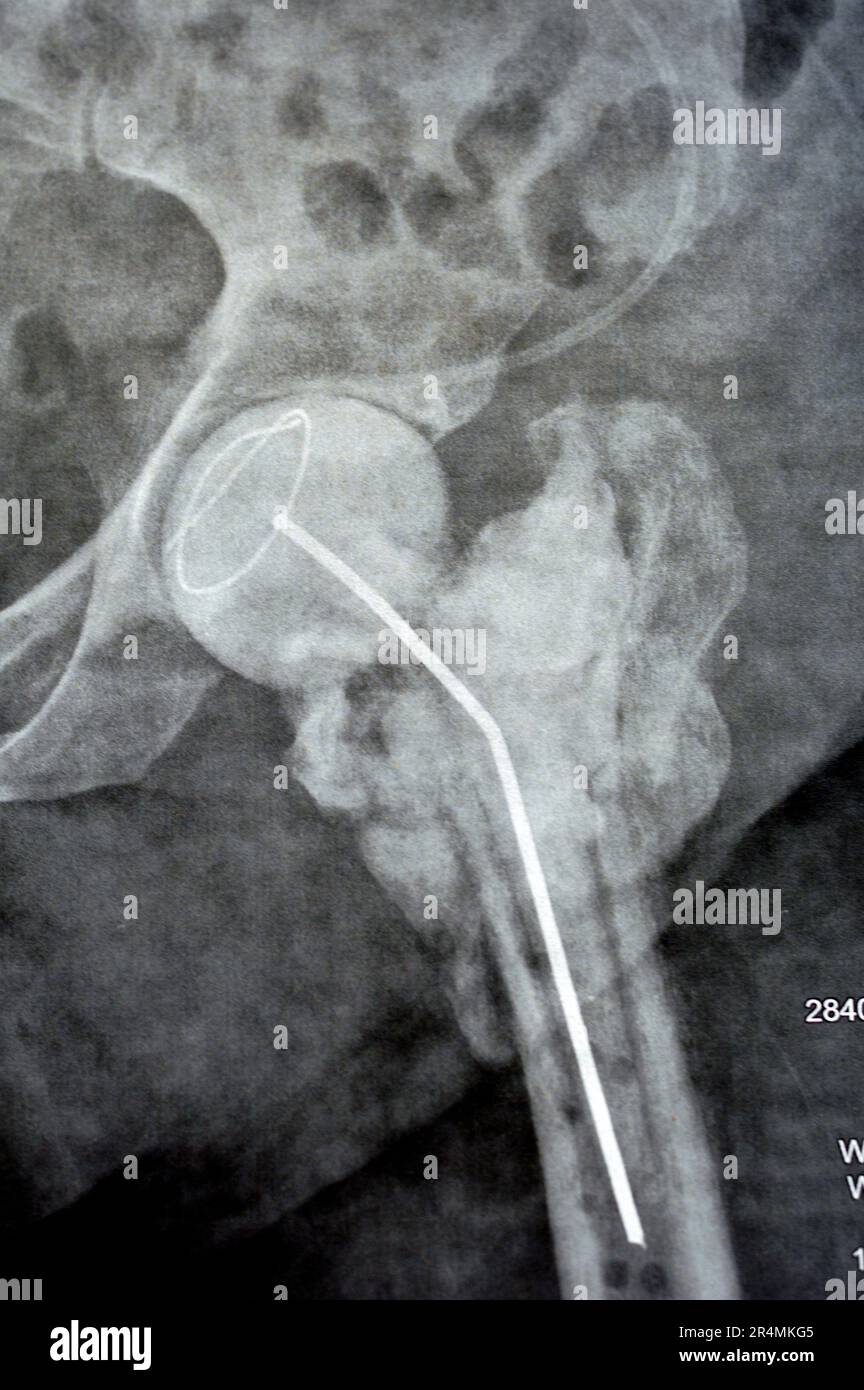 L'articolazione dell'anca a raggi X normali mostra la frattura trans cervicale sinistra della testa del femore con distanziatore temporaneo del caricatore antibiotico a poppa di cemento osseo caricato con antibiotici Foto Stock