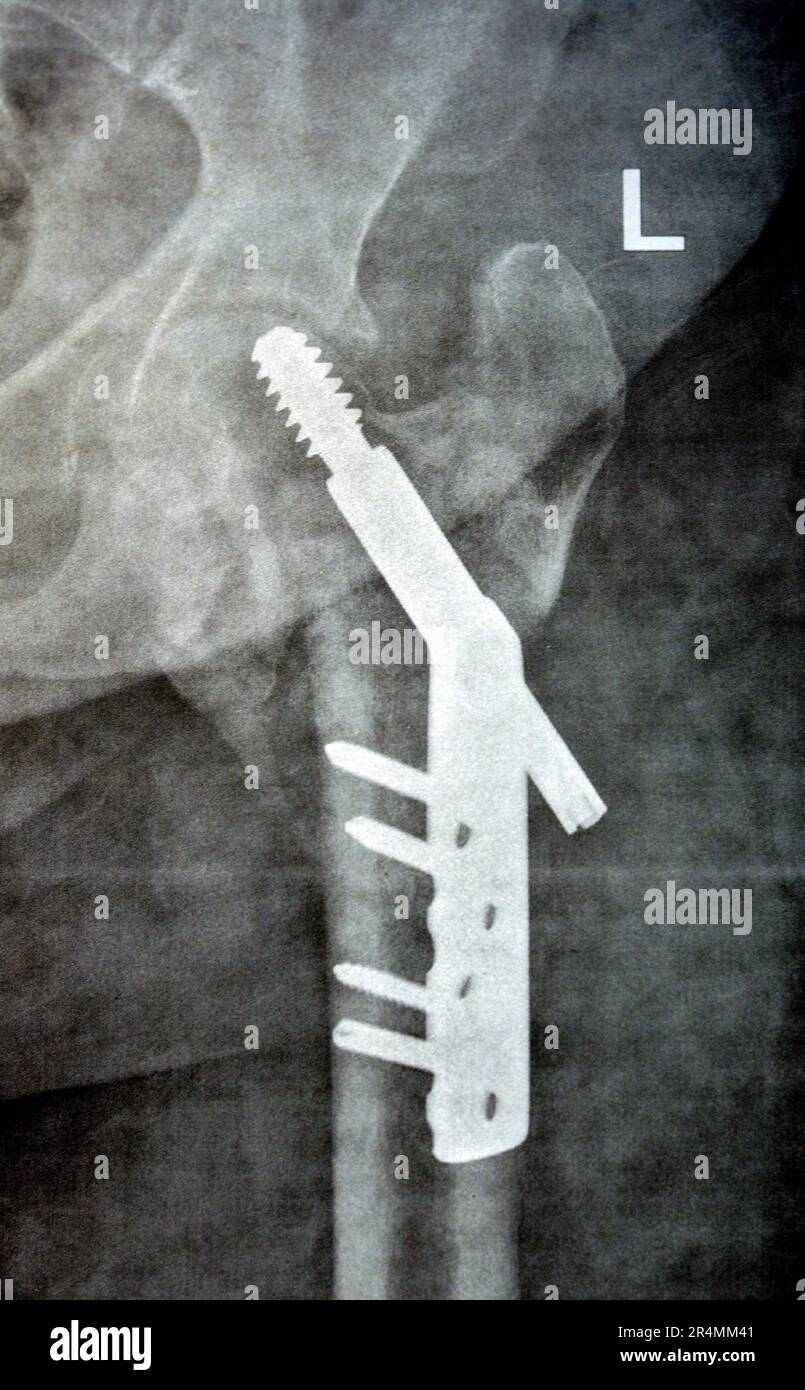 Collo cervicale trans dell'anca sinistra della frattura femorale fissato da DHS Dynamic Hip Screw, Plain x ray PXR di un vecchio paziente, una testa femorale-risparmiatore ortopedico Foto Stock