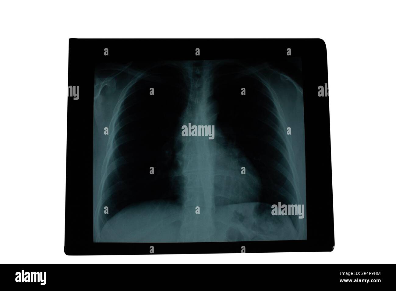 Radiografia posttoracica anteriore che mostra il parenchima polmonare con un pattern radiografico omogeneo e la prominenza del pulsante aortico nel paziente Foto Stock