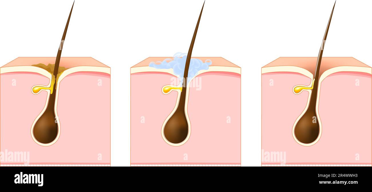 Pulire i pori e i capelli. Sezione trasversale della pelle umana con tappo cheratotico, capelli grassi o secrezione sebo eccessiva. Lavare la pelle con sapone Illustrazione Vettoriale