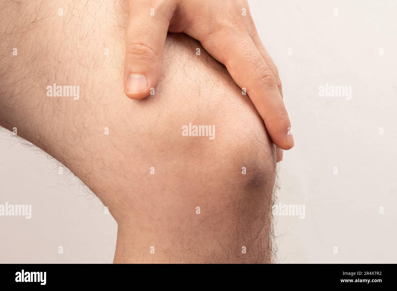 Lividi blu sulla gamba del ginocchio macro clsoe vista dall'alto isolato Foto Stock