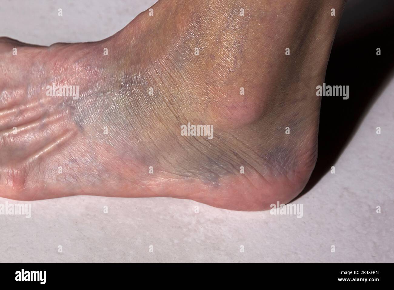 Primo piano di una caviglia distesa di una donna che è altamente scolorito. Modello rilasciato. Foto Stock