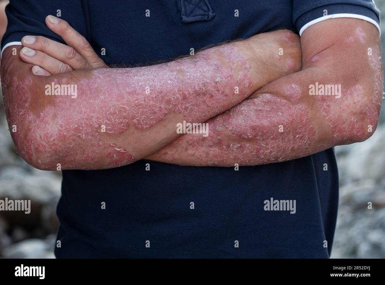 Malattie causate da anomalie della linfa. La psoriasi è una malattia della pelle Foto Stock