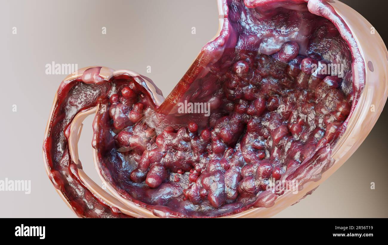 Cancro allo stomaco. Stadi di crescita tumorale nell'apparato digerente, ulcera peptica, cellule di attacco del cancro. concetto di malattia gastrica. sintomi, maligno canceroso, Foto Stock