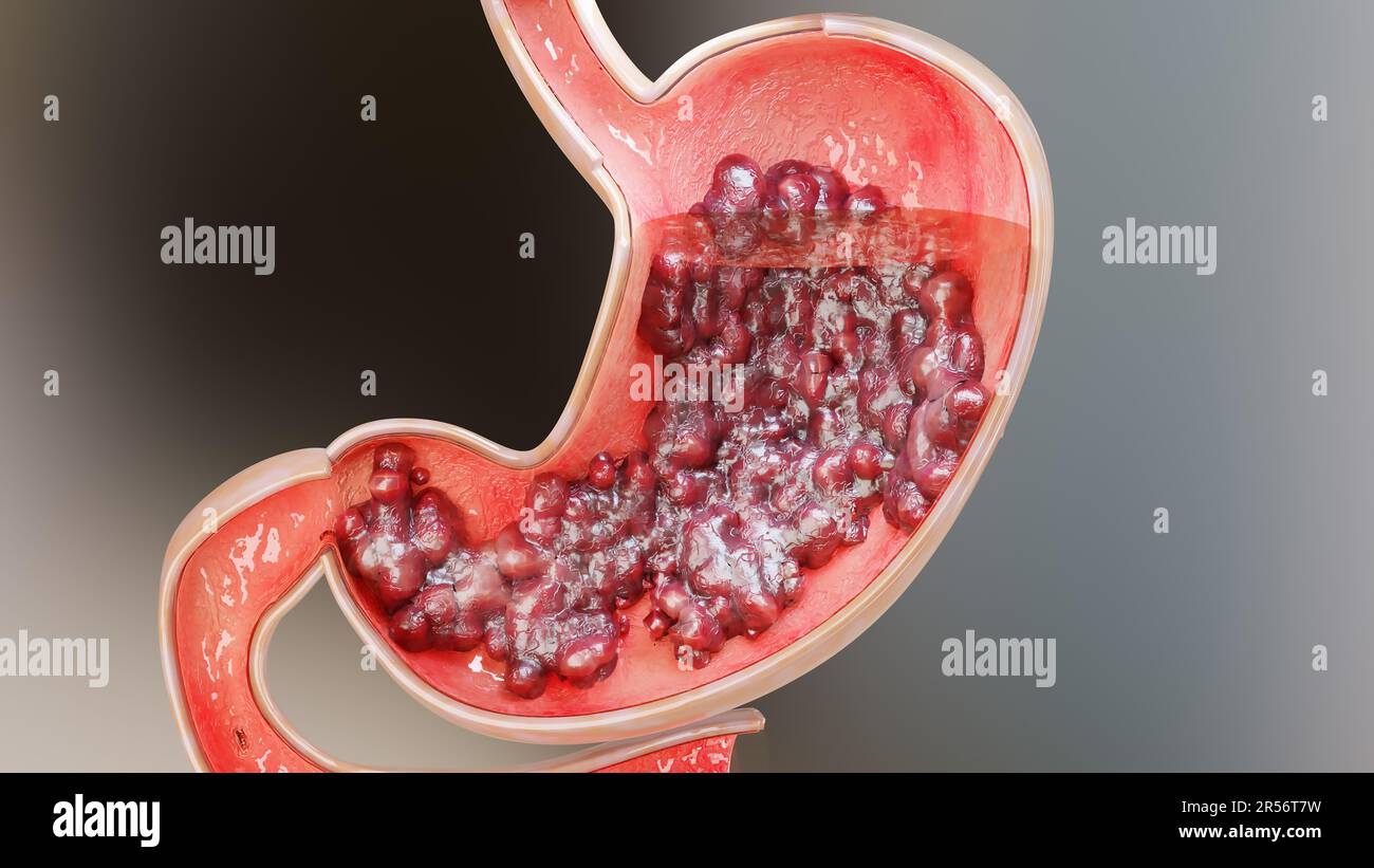 Cancro allo stomaco. Stadi di crescita tumorale nell'apparato digerente, ulcera peptica, cellule di attacco del cancro. concetto di malattia gastrica. sintomi, maligno canceroso, Foto Stock