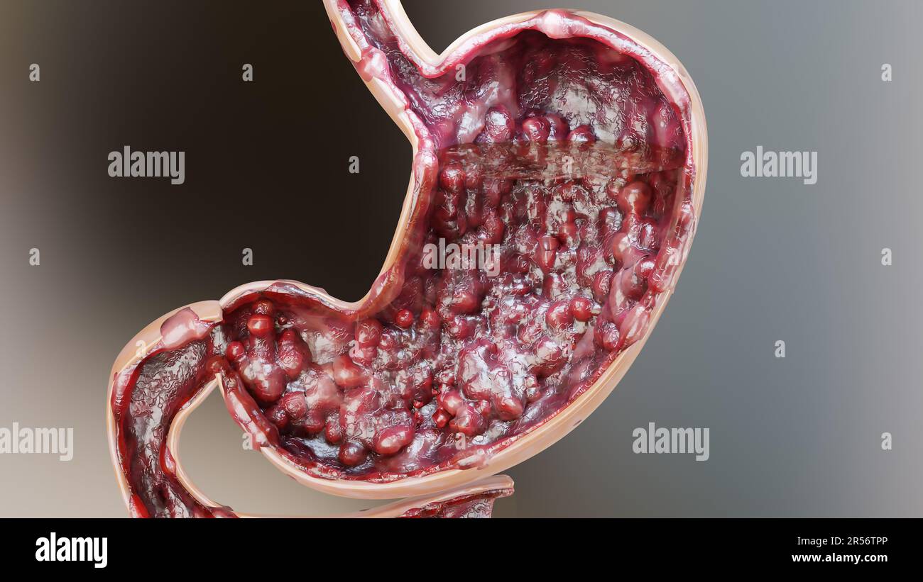 Cancro allo stomaco. Stadi di crescita tumorale nell'apparato digerente, ulcera peptica, cellule di attacco del cancro. concetto di malattia gastrica. sintomi, maligno canceroso, Foto Stock
