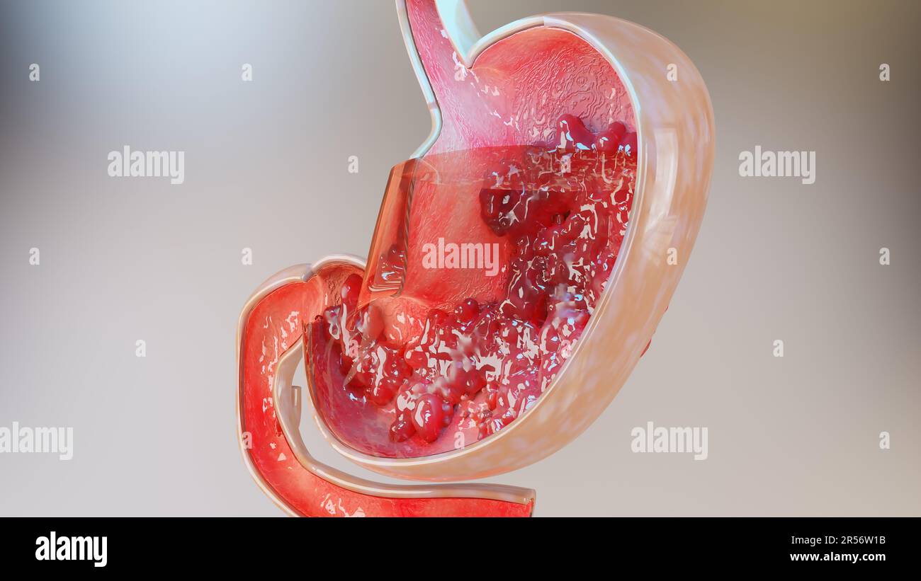 Cancro allo stomaco. Stadi di crescita tumorale nell'apparato digerente, ulcera peptica, cellule di attacco del cancro. concetto di malattia gastrica. sintomi, maligno canceroso, Foto Stock